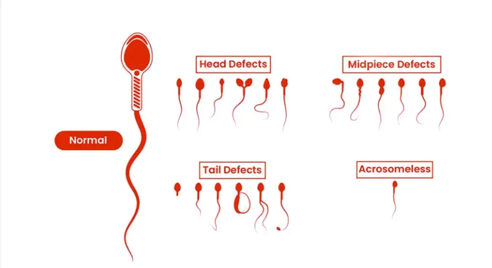  تشوهات الحيوانات المنوية