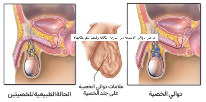 كيف تتشكل دوالي الخصية؟