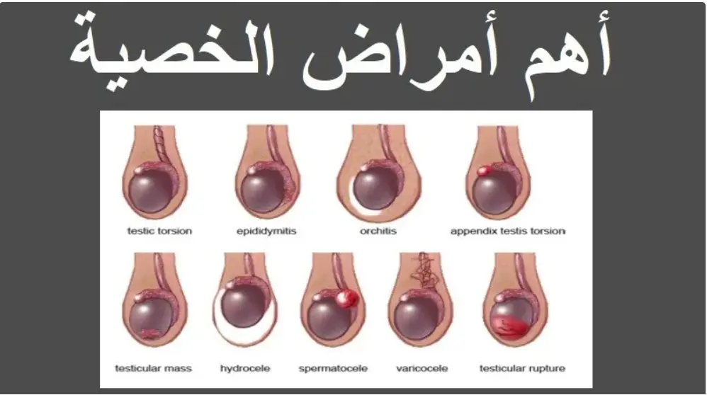  امراض الخصية 