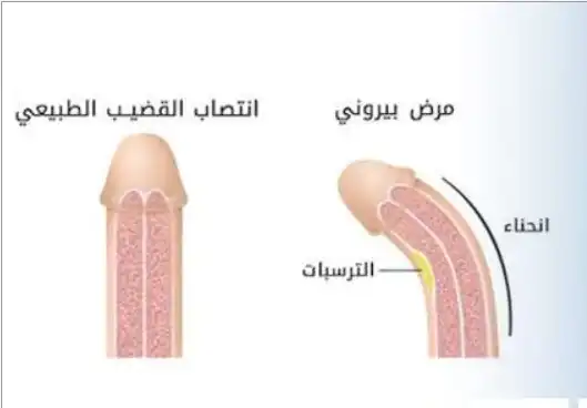 مرض بيروني - قبل وبعد